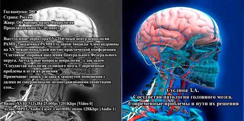 Суслина З.А. Сосудистая патология головного мозга. Современные проблемы и пути их решения