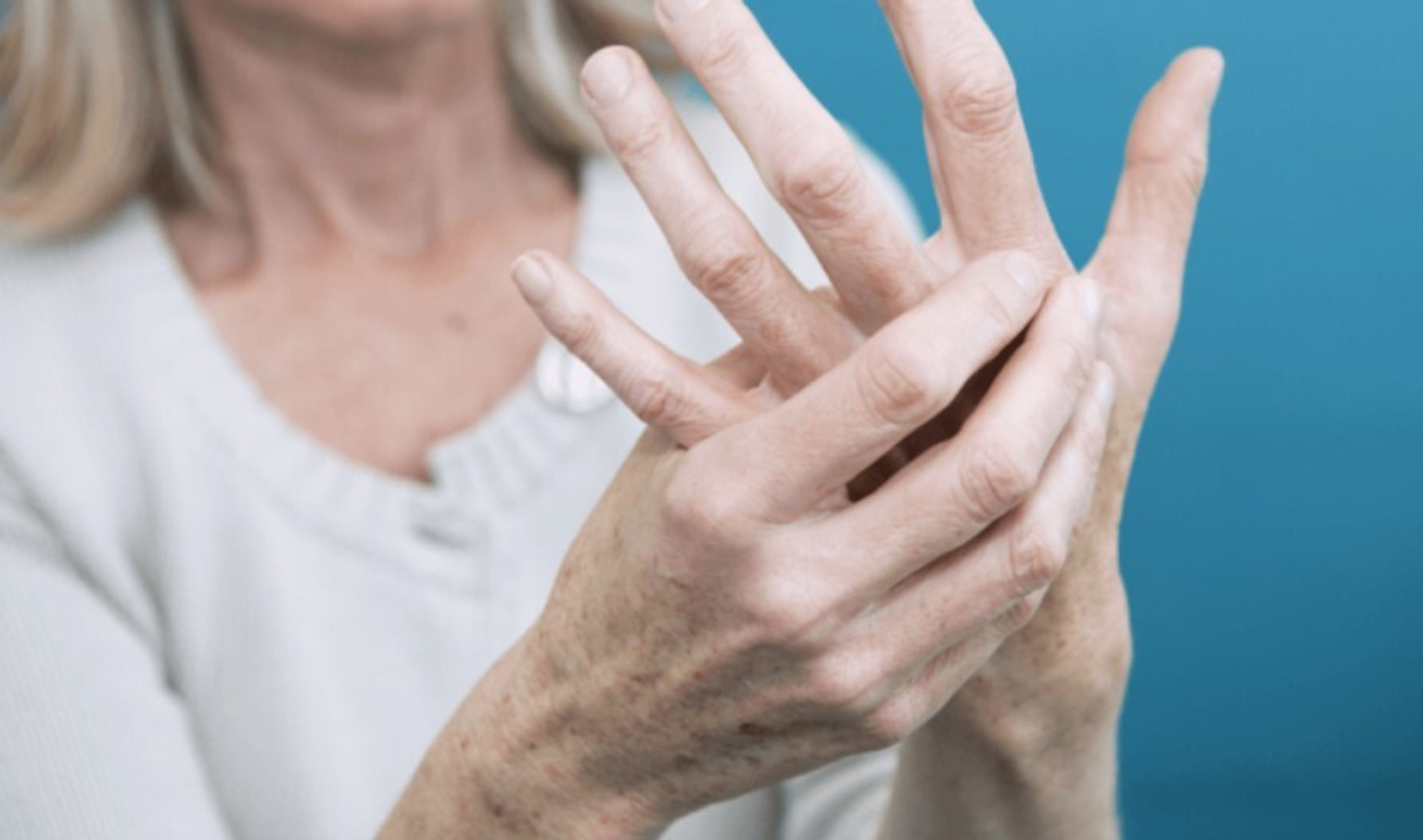 Болезнь суставов артрита. Руки больного ревматоидным артритом.