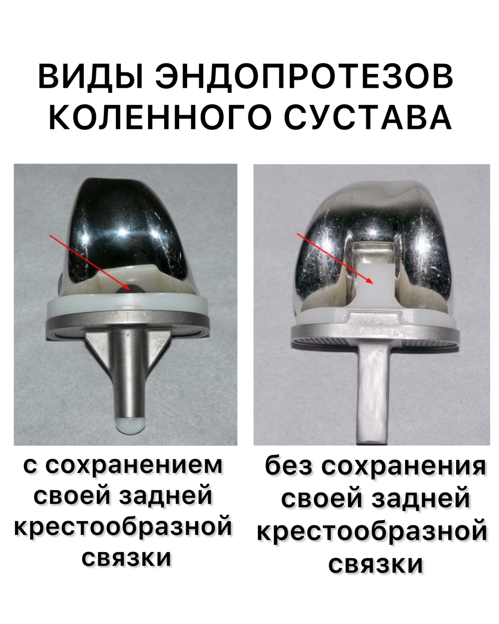 Эндопротез коленного сустава виды