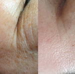 RelaxSim Ampoule Eldermafill | Пептидный миорелаксант