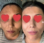 PDRN Glutathione Ampoule Eldermafill | Сияние и реструктуризация