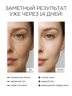 СЫВОРОТКА ОТ ГИПЕРПИГМЕНТАЦИИ