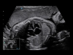 Аппарат УЗИ SIUI Apogee 5500 Exp