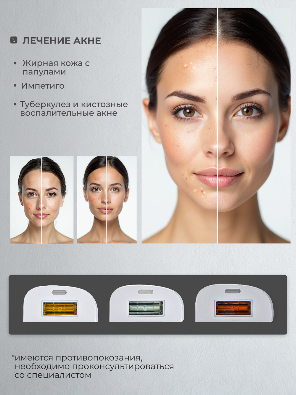 Фотоэпилятор Mismon MS-212B – домашний IPL эпилятор для удаления волос