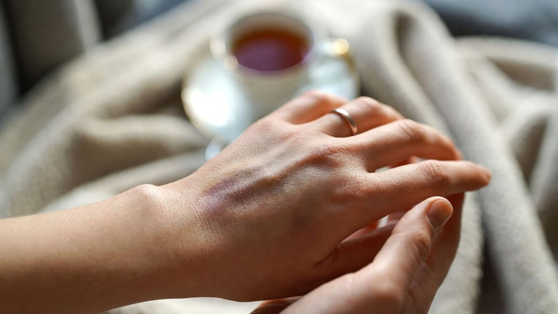 Синяки на теле без причины: сигнал тревоги от ваших сосудов