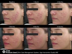 JAN MARINI AGE INTERVENTION DUALITY MD 0,9 % Крем-акселератор с ретинолом 0,9% для решения проблем возрастного акне