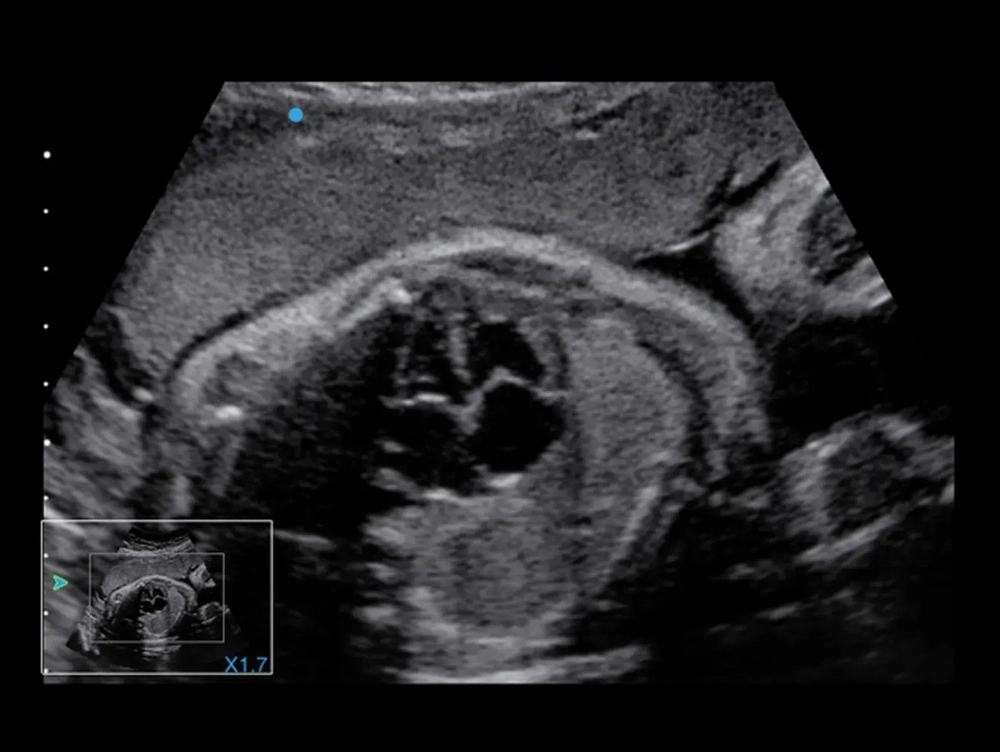Аппарат УЗИ SIUI Apogee 5500 Exp