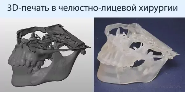 Применение 3D-печати в челюстно-лицевой хирургии