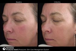 JAN MARINI ROSALIEVE Крем-акселератор для комплексного решения проблем розацеа