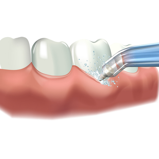 Пародонтальная насадка GoFlow (1 шт.)