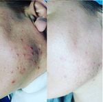 PDRN Rejuvenating Ampoule Eldermafill | Мощная регенерация