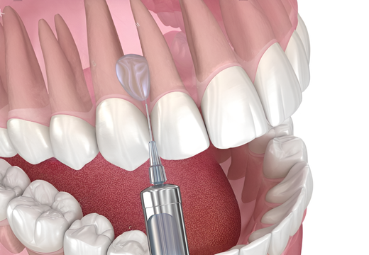 Инфильтрационная, проводниковая анестезия