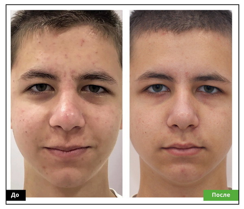 BioRePeelCl3 FND | Пилинг для лица