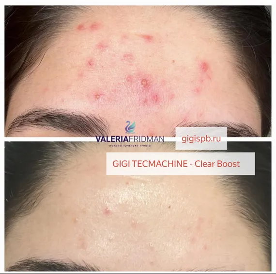 Бустер для противовоспалительной терапии