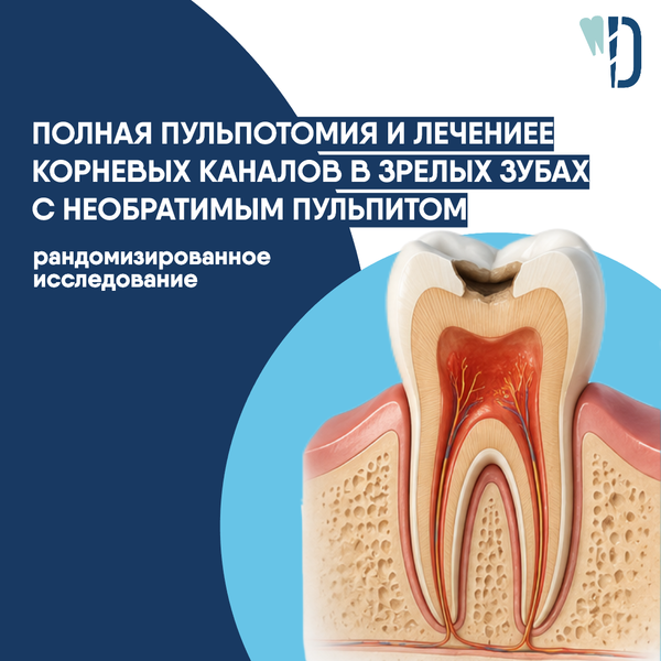 Полная пульпотомия и лечение корневых каналов в зрелых зубах с необратимым пульпитом: рандомизированное исследование