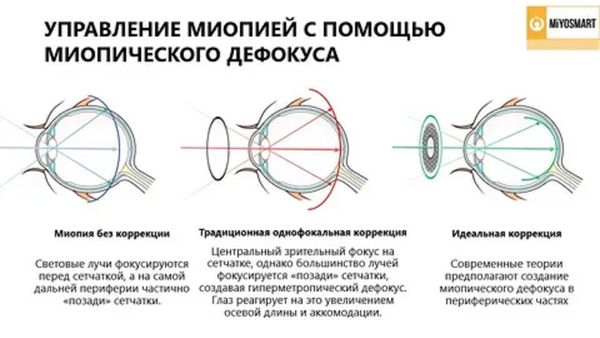 Дефокусные линзы для контроля миопии от ведущих брендов