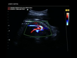 Аппарат УЗИ (сканер) Samsung Medison HM70