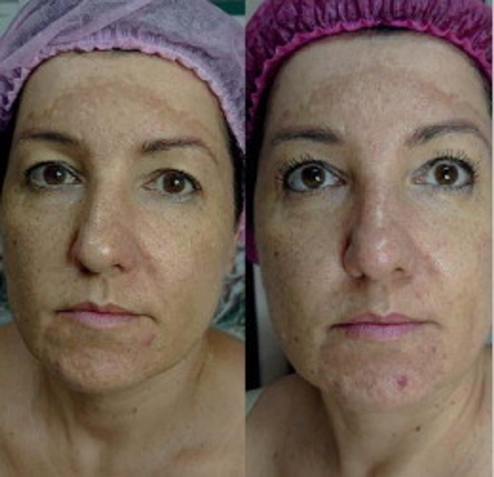 PDRN Glutathione Ampoule Eldermafill | Сияние и реструктуризация