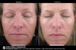 JAN MARINI AGE INTERVENTION RETINOL PLUS MD 1% Крем-акселератор с ретинолом 1% для борьбы с видимыми возрастными изменениями