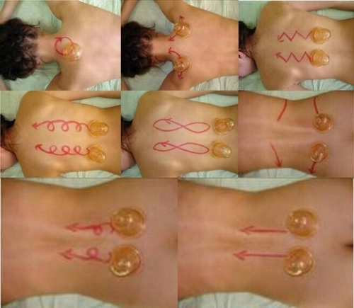 Банка массажная полимерная 1 шт диаметр 6 см