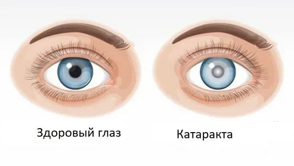 Почему перед подбором очков при катаракте необходимо посетить офтальмолога?