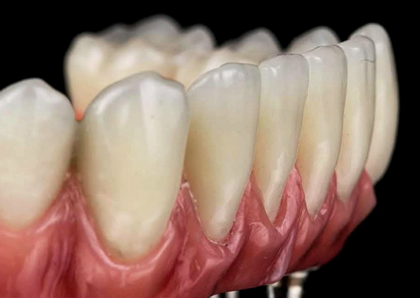 Каркас тотального протеза из ПИИКа БиоХПП (РЕЕК, ВіОНРР) bredent