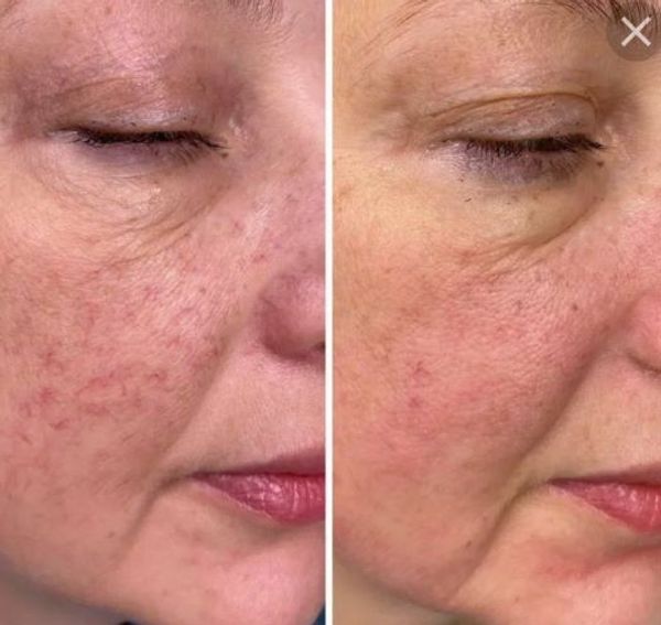 Уход за чувствительной кожей зимой Уход за чувствительной кожей зимой