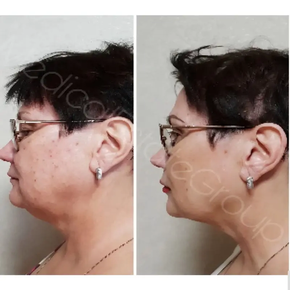 Light Fit | Липолитик прямой