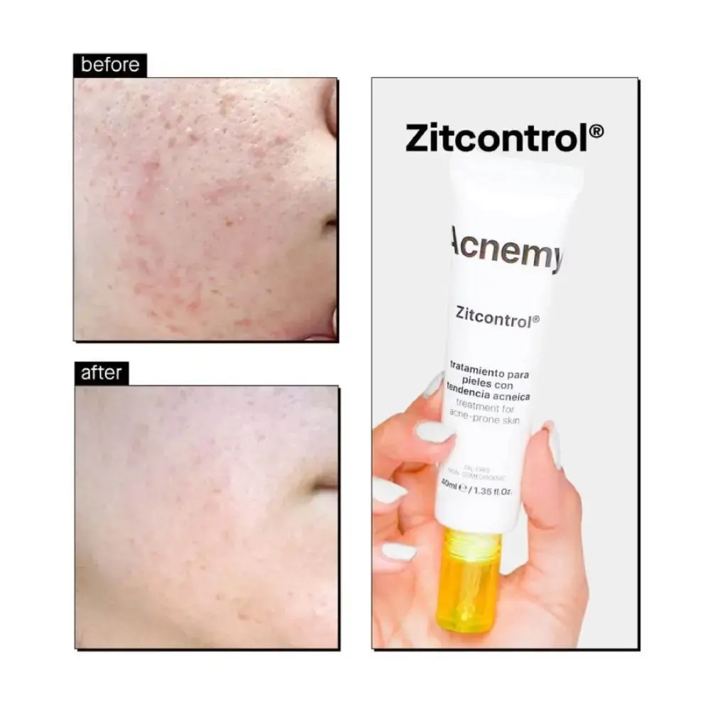 Крем Acnemy ZitControl с салициловой кислотой для контроля акне