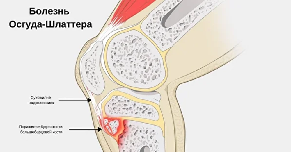 Jumper's Knee Strap, Unisex, Black - OSFM