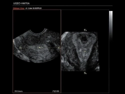 Аппарат УЗИ (сканер) Samsung Medison HM70