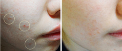 Ciracle Anti-blemish Toner тонер для проблемной кожи