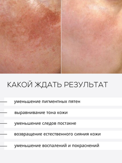 СЫВОРОТКА ОТ ГИПЕРПИГМЕНТАЦИИ