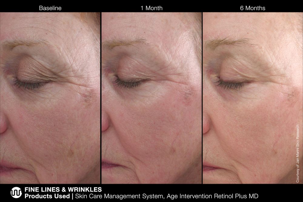 JAN MARINI AGE INTERVENTION RETINOL PLUS MD 1% Крем-акселератор с ретинолом 1% для борьбы с видимыми возрастными изменениями