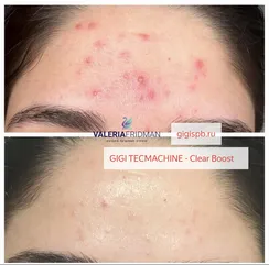 Бустер для противовоспалительной терапии