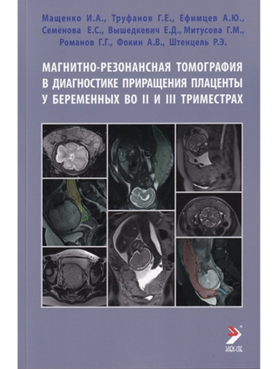 Магнитно-резонансная томография в диагностике приращения плаценты у беременных во II и III триместрах