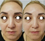 PDRN Booster Eldermafill | Усилитель мезотерапии