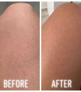 Скраб для тела First Aid Beauty KP Bump Eraser Body Scrub with 10% AHA 226 г