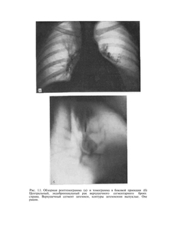 Дифференциальная рентгенодиагностика заболеваний органов дыхания и средостения. Том 1 | Л.С. Розенштраух; М.Г. Виннер