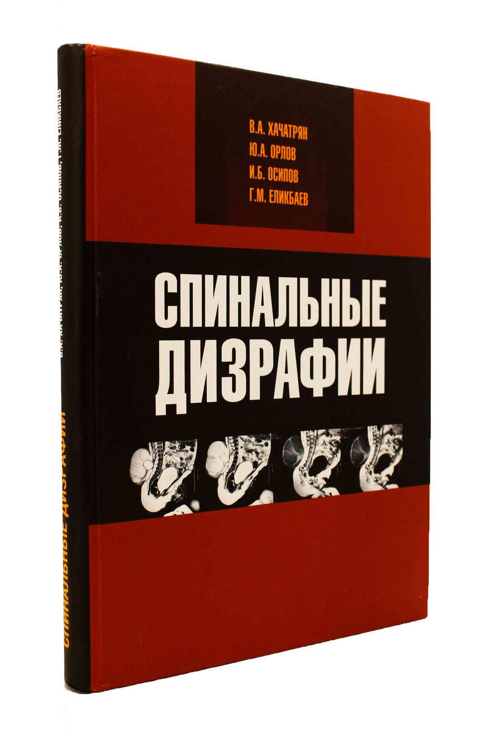 Спинальные дизрафии: нейрохирургические и нейроурологические аспекты