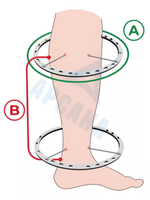 Чехол на аппарат внешней фиксации (Илизарова и др.) на голени (без полуколец). Легкий (хлопок + полиэстер), с открытой стопой./ ГО-16.