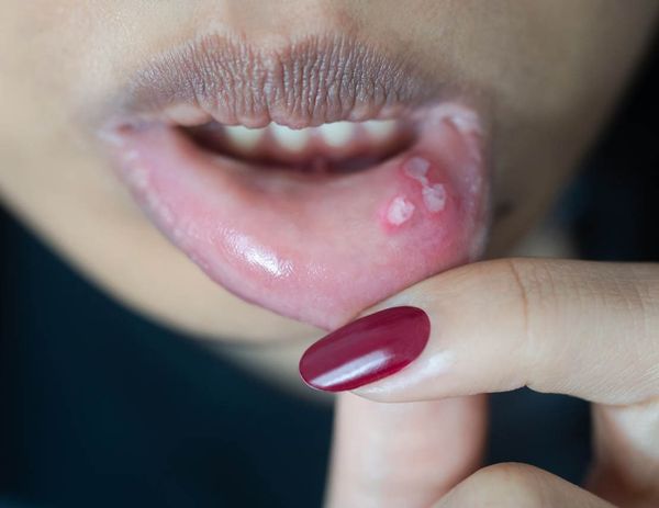 Деликатная проблема – молочница…