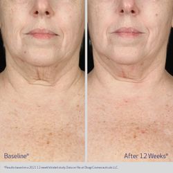 Obagi Medical Омолаживающая и укрепляющая сыворотка для зоны шеи и декольте Elastiderm Neck and Decollete Lifting Concentrate 60 мл