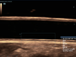 Аппарат УЗИ (сканер) Mindray DC-80 Exp