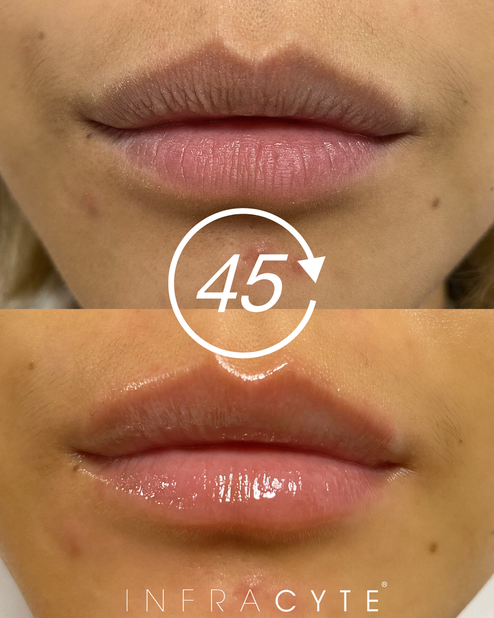 L.I.T. (Lip Infusion Therapy) 4 патч-маски