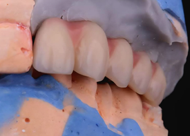 Замещающий фрагмент, из ПИИКа БиоХПП (РЕЕК, ВіоНРР) bredent