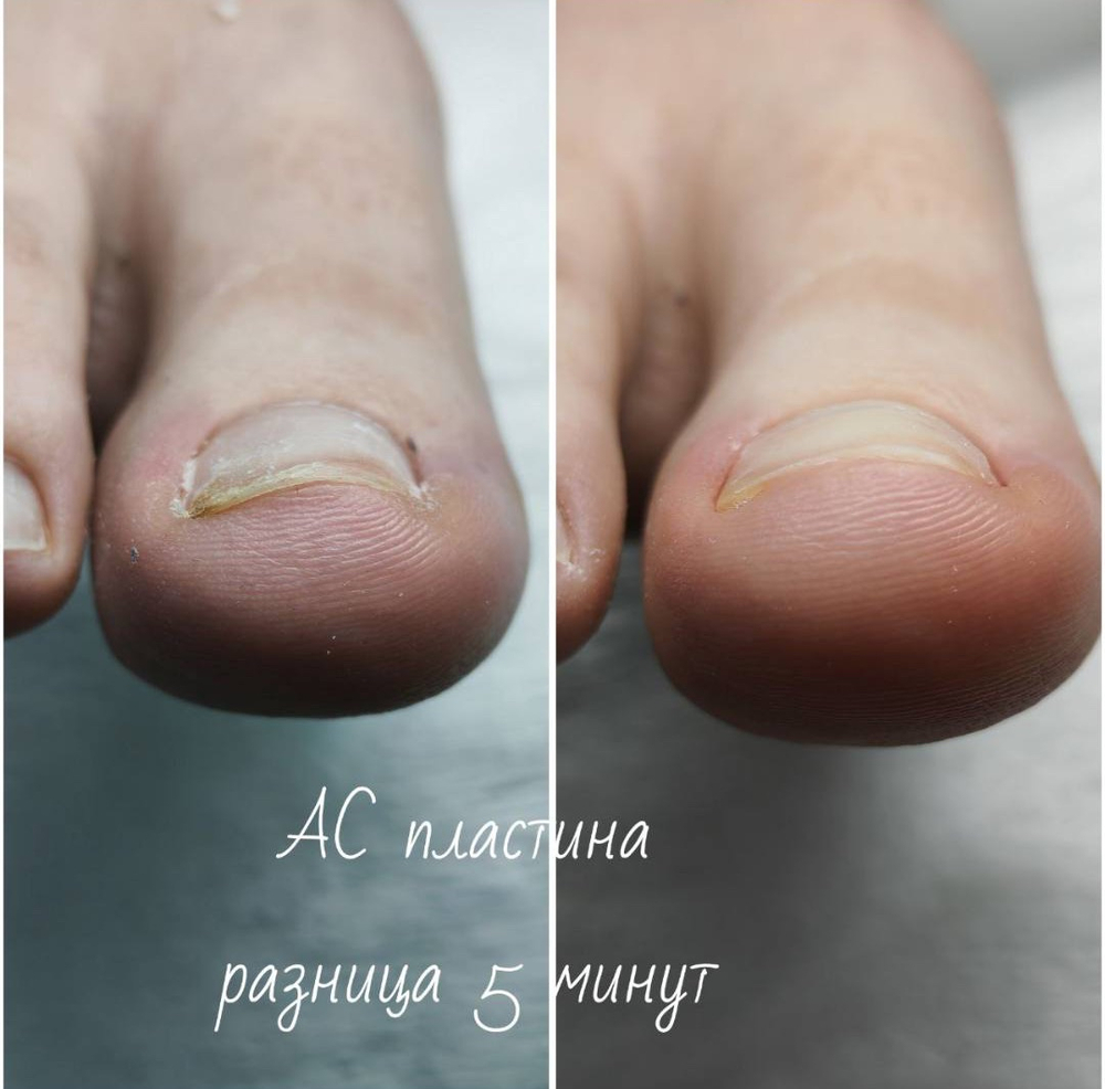 Набор AС пластин плюс клей и стилус