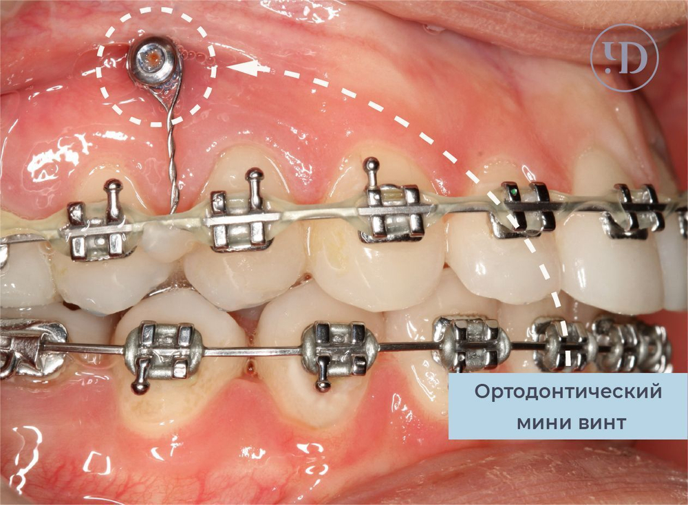 Минивинт ортодонтический 1,6*10