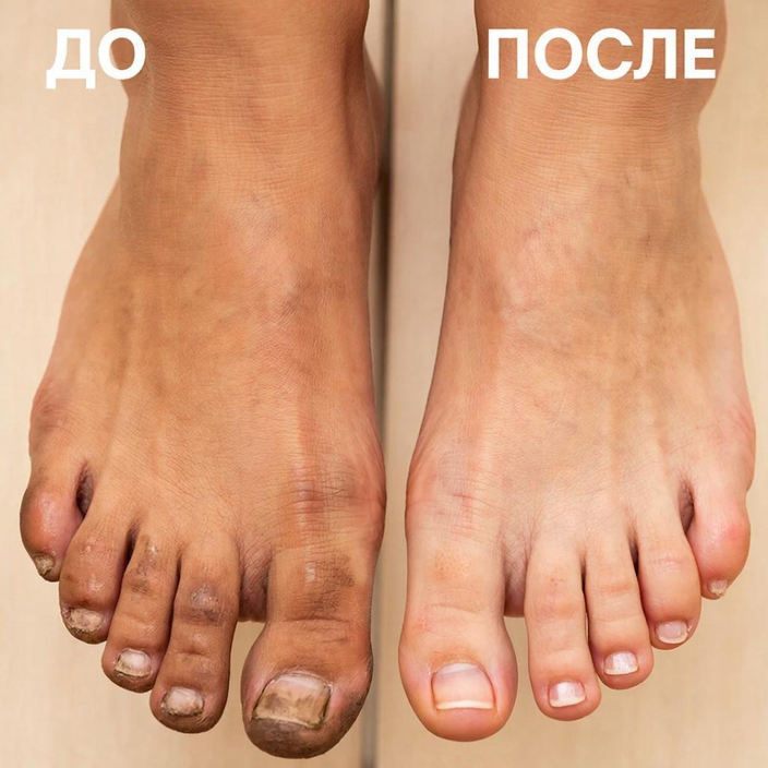 Гигиена пальцы на ногах