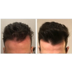 ASCE+ HRLV ExoCoBio | Лиофилизированный порошок экзосом для восстановления кожи головы и волос